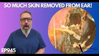 SO MUCH SKIN REMOVED FROM PATIENTS EAR CANAL  EP945 [upl. by Annahtur]