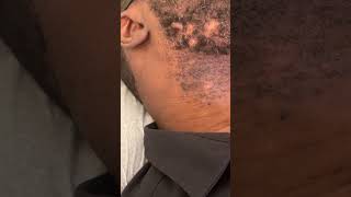 Keloid of Face  Treatment with cryotherapy [upl. by Alemat2]