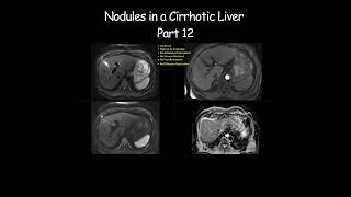 Nodules in a Cirrhotic Liver  Part 12 radiology radiologist cirrhosis liverdisease liverhealth [upl. by Jolie]