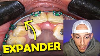 Palatal Expanders for ADULTS with BRACESOrthodontist explains MARPE [upl. by Aneeb]