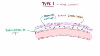 Membranoproliferative glomerulonephritis MPGN causes symptoms amp pathology [upl. by Nofpets]