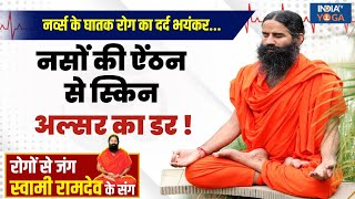 YOGA LIVE Skin Ulcer का लोगों में क्यों बढ़ रहा खतरा योग देगा दर्दनाक बीमारी से राहत Swami Ramdev [upl. by Adarbil]