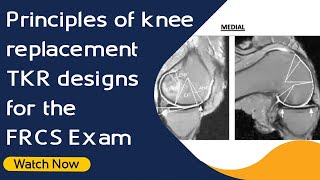 Principles of knee replacement TKR designs for the FRCS Exam  Orthopaedic Academy [upl. by Novikoff975]