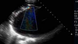 Giant left atrium due to rheumatic mitral stenosis and regurgitation [upl. by Eiznil798]