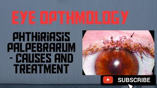 Phthiriasis palpebrarum Cause amp Treatment [upl. by Small]