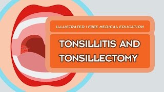 What is Tonsillitis amp Tonsillectomy [upl. by Anaiuq481]