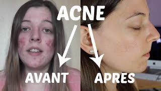 ACNE  Mon expérience et traitements naturels [upl. by Honna]