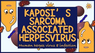 Kaposi Sarcoma Associated Herpes virus HHV 8 Morphology Diagnosis Treatment amp Prevention [upl. by Trillby]