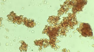 Severe agglutination reaction and transfusion incompatibility [upl. by Lleraj]