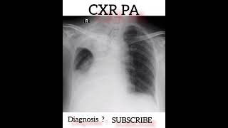 Diagnosis  Chest X Ray  Practical case  Radiology [upl. by Eniksre982]