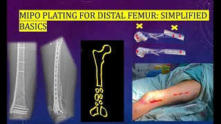 MIPO plating for distal femur fractures NON GRAPHIC [upl. by Damiani]