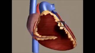 Infarto Agudo do Miocárdio [upl. by Ostler]