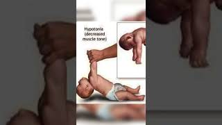 hypotonia baby parenting trending memes youtubeshorts shortsfeed [upl. by Ahsinyd]