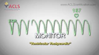 Ventricular Tachycardia by ACLS Certification Institute [upl. by Oigimer]