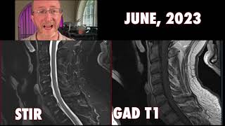 Scary Spinal MRI Multiple Sclerosis Spinal Cord [upl. by Netsruk173]