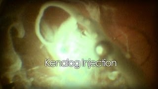 Intravitreal Kenalog Injection [upl. by Ateloiv236]