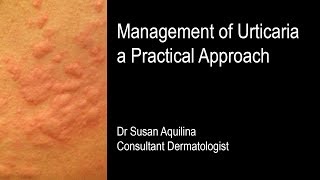 Management of Urticaria a Practical Approach [upl. by Diane]