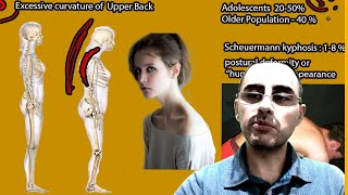 Kyphosis  Symptoms and causes and treatment [upl. by Noellyn]