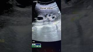 Kidney stoneRenal stoneUreteric stone stone kidney ultrasound reels shorts ultraradiology [upl. by Emmuela]