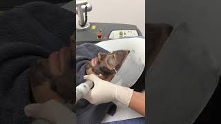 Carbon Laser Facial Brisbane [upl. by Cotsen]