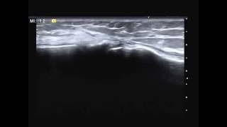 Infrapatellar branch of the saphenous nerve [upl. by Ahsied]