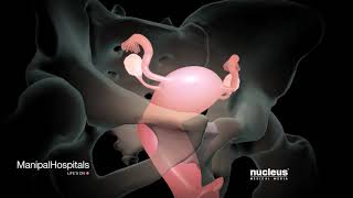 How Is A Robotic Hysterectomy Done  Robotic Hysterectomy Surgery  Gynaecology  Manipal Hospitals [upl. by Benedict]