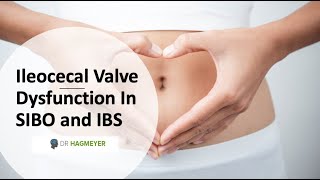 Healing The Ileocecal Valve amp Why Its Important In SIBOIBS [upl. by Namra]