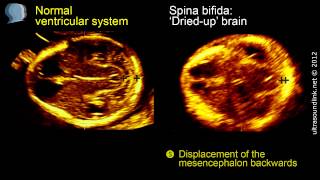 Spina bifida 3D ultrasound diagnosis at 1113 weeks [upl. by Aloiv172]