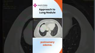 Approach to Lung Nodule  Medvarsity [upl. by Moody]