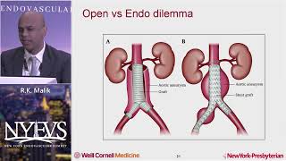 Endovascular Management of Infrarenal Abdominal Aortic Aneurysms in 2022 R K Malik Endo Fellow [upl. by Haseena]