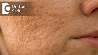 How to remove Acne scars by natural remedies  Dr Chetali Samant [upl. by Marylou]