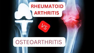 Differences between Osteoarthritis Vs Rheumatoid Arthritis [upl. by Ilehs]