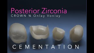 Zirconia Ceramics Part 5 Posterior Onlay 34 Vonlay and Crown Cementation [upl. by Hendricks712]