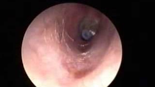 Otitis media Serosa Diagnostico y resolucion Quirurgica [upl. by Otrebire]