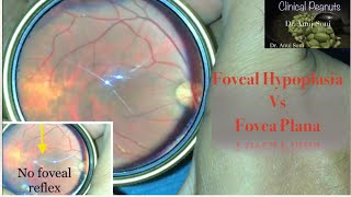 Clinical Peanuts Foveal HYPOPLASIA In albinotic Fundus [upl. by Suh]