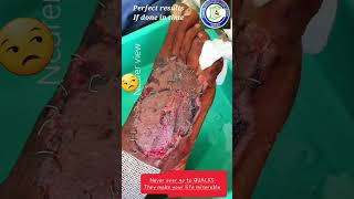 Wound Debridement  Dorsum foot degloving going I to Gangrene  Excision amp Skin grafting Adamya Hsp [upl. by Aken639]