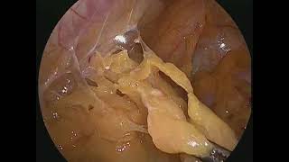 laproscopy myomectomy with grade 4 endometriosis conservation surgery [upl. by Emad]