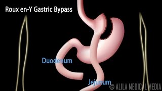 Roux enY Gastric Bypass with Introduction on Body Mass Index Animation [upl. by Nirehtac]