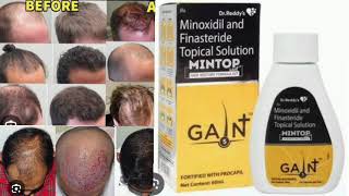 Mintop Gain  Hair Restore Formula Kit Minoxidil and Finasteride Topical Solution [upl. by Octavian186]