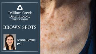 What are those Brown Spots on your skin [upl. by Edak]