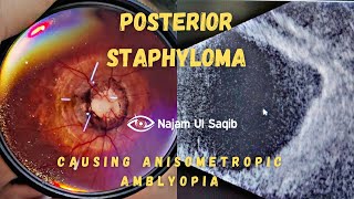 Posterior Staphyloma Causing Myopic Anisometropic Amblyopia [upl. by Ajdan]