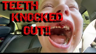 TEETH KNOCKED OUT [upl. by Stein]