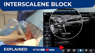 UltrasoundGuided Continuous Interscalene Block  Regional anesthesia Crash course with Dr Hadzic [upl. by Tongue]