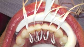 Retanium Splint Placement Orthodontics [upl. by Dehlia]