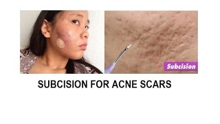 Acne scar treatment Subcision and TCA cross [upl. by Haleigh]