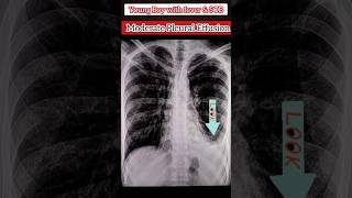 Pleural Effusion on XRay Chest 🩻 medical xray diagnosis radiology ultrasound shorts [upl. by Eahsed]