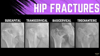 Hip Fractures and Treatment Methods Explainer with Xray examples [upl. by Engelhart]