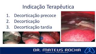 Decorticação Pulmonar  Empiema pleural [upl. by Sami391]