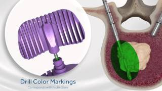 OsteoCool RF Ablation Animation [upl. by Eurd656]