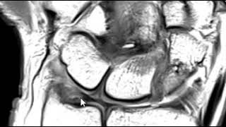 Triangular fibrocartilage TFCC tear [upl. by Artapoelc59]